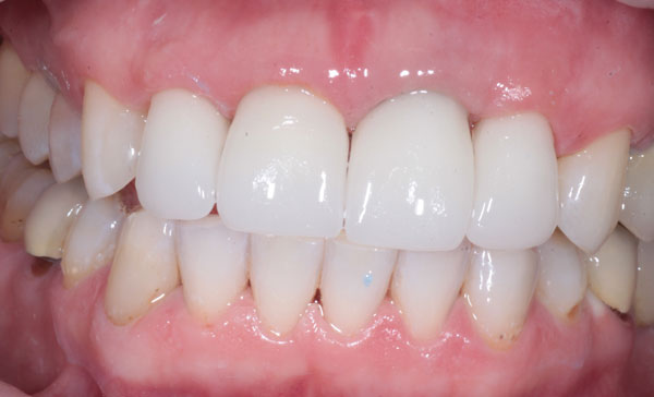 Коронка на зуб фото до и после