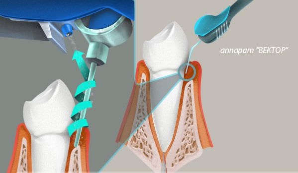 Лечение десен аппаратом vector в спб