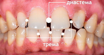 Тремы между зубами фото