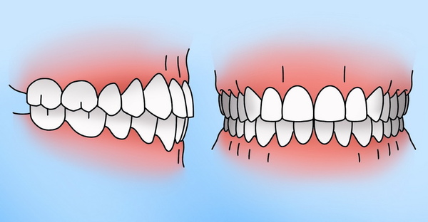 Правильный прикус и неправильный прикус картинки