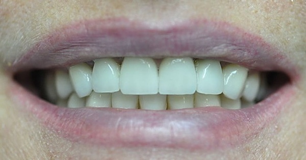 Коронки на передние зубы фото